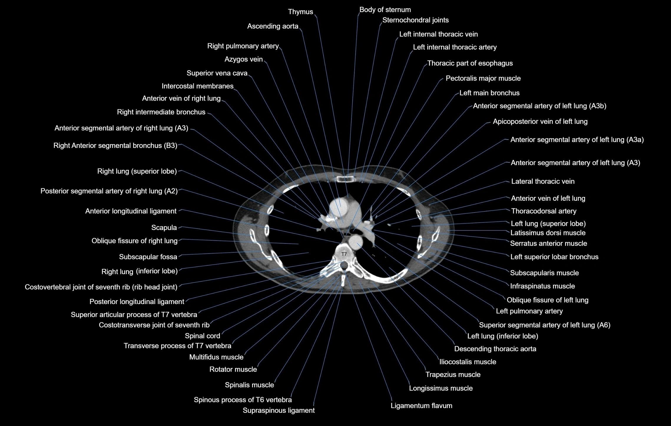 CT chest (thorax) labelled axial cross sectional anatomy radiology image-00054.webp